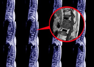 Vertebral Compression Fracture – NJ Spine Center