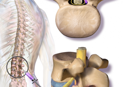 Epidural Spinal Steroid Injection In Nj Seacoast Spine And Sports Medicine